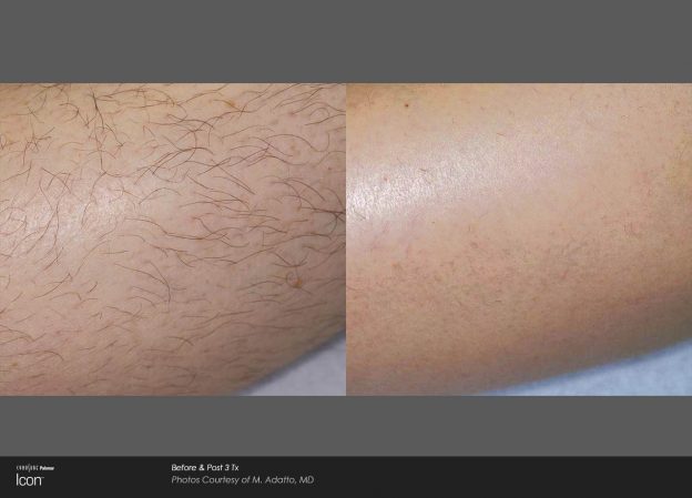 bloom-Hair-Removal-Before-&-After-Photo-2