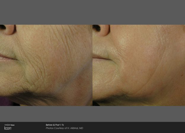 bloom-Skin-Resurfacing-Before-&-After-Photo-2
