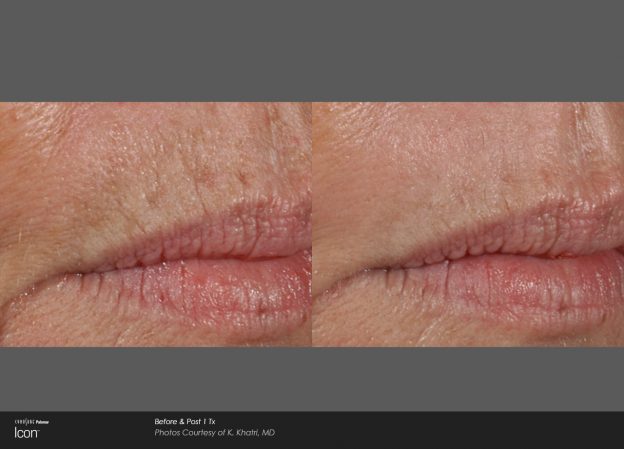 bloom-Skin-Resurfacing-Before-&-After-Photo-3