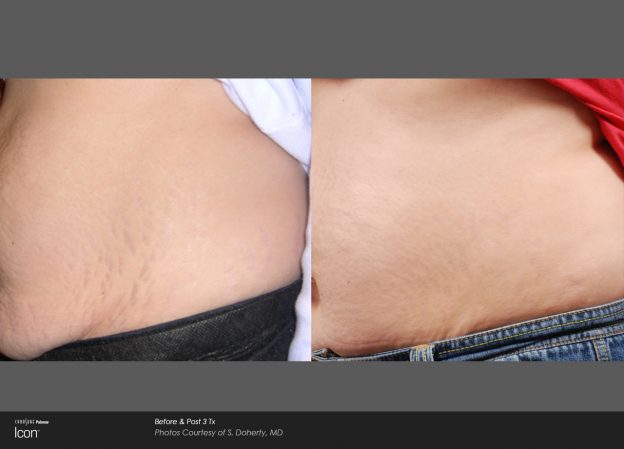 bloom-Stretch-Mark-Before-&-After-1