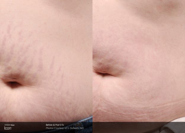 bloom-Stretch-Mark-Before-&-After-4