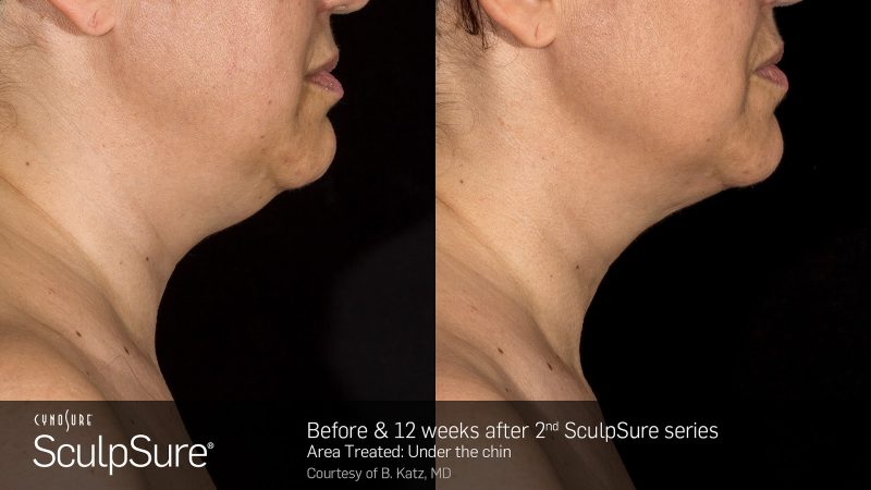 bloom-sculpsure-doublechin