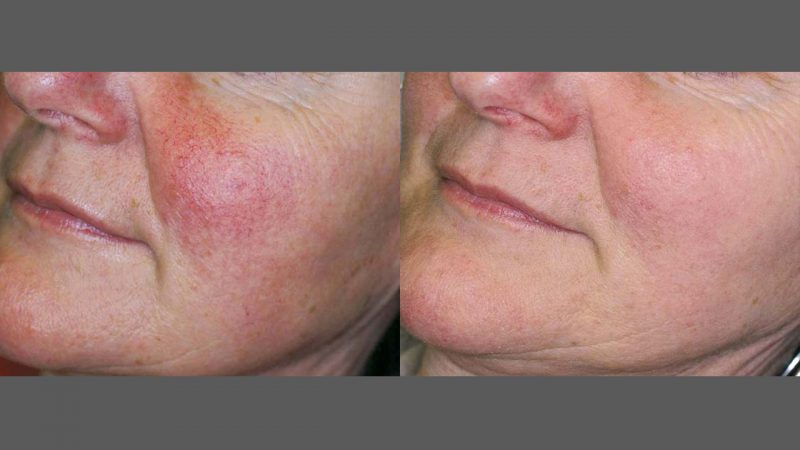 bloomobgyn-photorejuvenation1