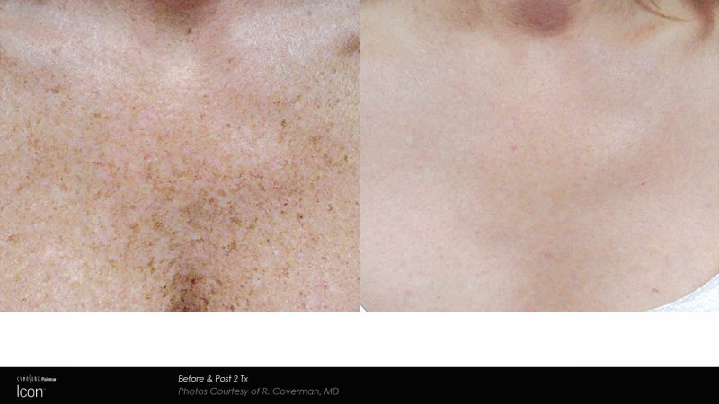 bloomobgyn-photorejuvenation3