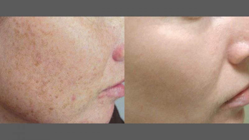 bloomobgyn-photorejuvenation4
