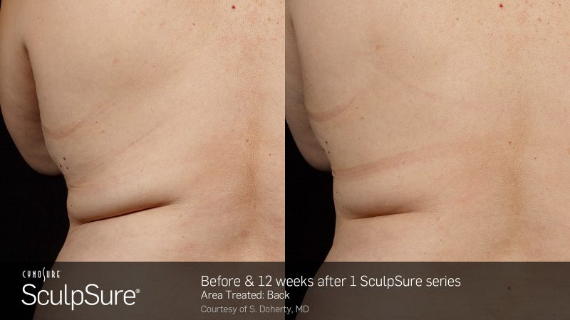 bloomobgyn-backfat-before-after-1