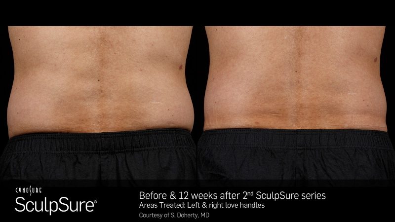 bloomobgyn-backfat-before-after-2