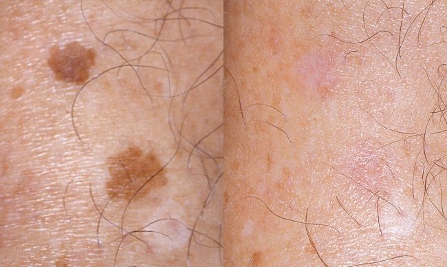 bloomobgyn-brown-spots-melasma-before-after-1