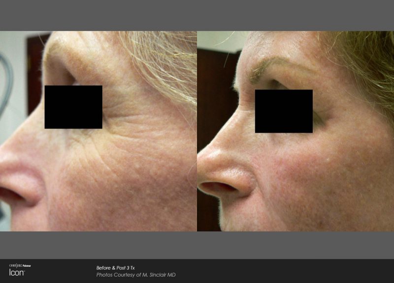 bloomobgyn-crows-feet-before-after-1