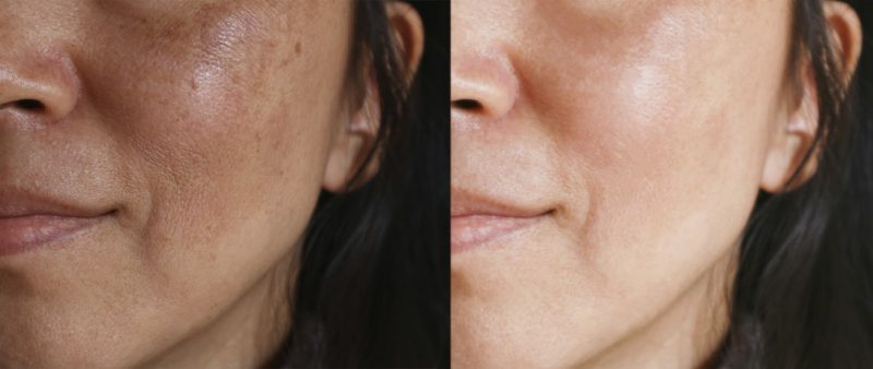 Before and after facial treatment concept. Face with melasma and brown spots and open pores.