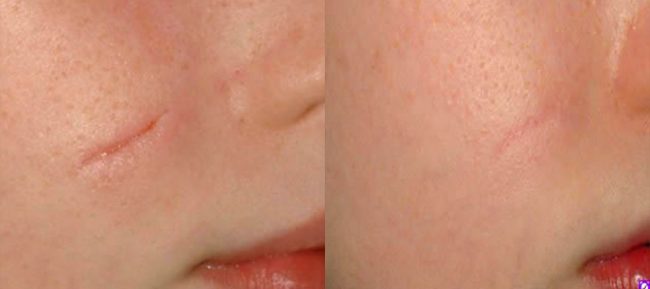 bloomobgyn-scars-before-after
